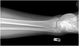 X-ray of a broken ankle