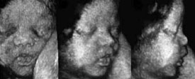 3D ultrasound baby