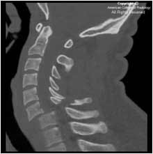 CT scan, car accident