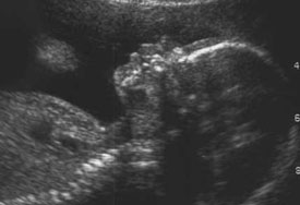 ultrasound of fetus head