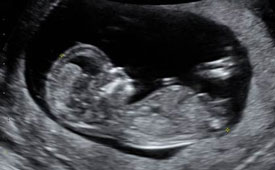 ultrasound fetus