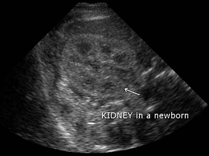 Sonogram - short axis or transverse view of the right kidney in a newborn.