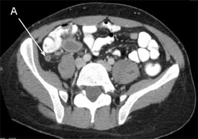 Appendicitis: The appendix (A) is distended and inflamed. In this patient the appendix has not yet ruptured.