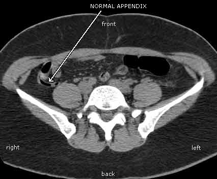 CT scan of a normal appendix in the right lower abdomen. The appendix normally connects with the right colon and contains air (this appears black on the scan). Air in the appendix excludes appendicitis since this means that the appendix is not obstructed or inflamed.