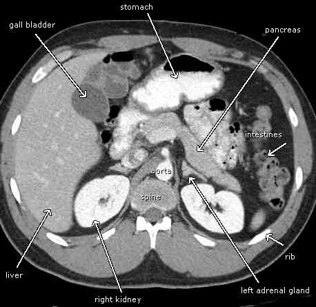 CT slice through the mid-abdomen showing multiple normal-appearing organs, which are labeled.