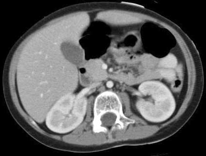 Normal CT of the abdomen.  A CT 'slice' through the upper abdomen of a child illustrates the normal appearance of both kidneys, the liver and gallbladder.