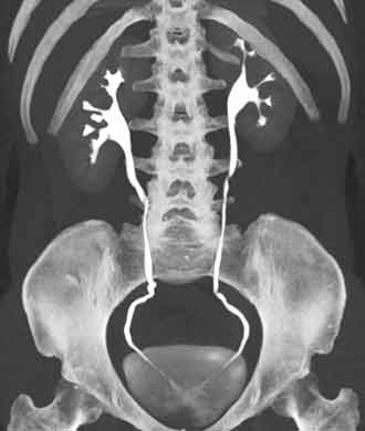 A 3D reconstructed CT view of the kidneys and ureters, which connect the kidneys to the bladder. Part of the ribs, spine and pelvis are included in this image.