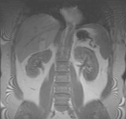 MR of the abdomen showing liver and kidneys - frontal (coronal view)