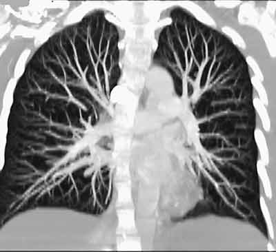 CT angiogram. Frontal or coronal view of chest-3D slab image showing pulmonary vessels.