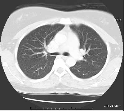 CT of the lungs, window level set to demonstrate the vessels and air ways - not intended to demonstrate the heart, spine muscles etc.  This is used to look for things like pneumonia or lung cancer.