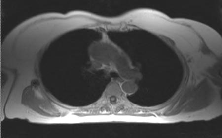 MRI of the chest. Patient is lying on his back. Lungs are black, aorta and pulmonary arteries are grey, shoulder muscles are grey and fat under the skin is white on this sequence.