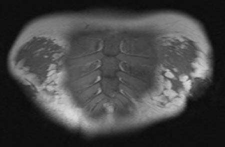 MRI of the sternum, ribs and portions of both breasts, looking at the patient from the front.