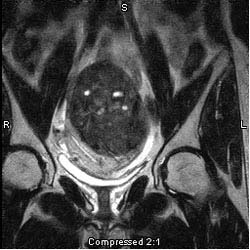 Catheter embolization Image: Coronal MR pelvis, large fibroid