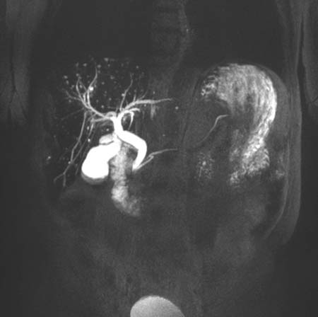 Magnetic resonance cholangiopancreatography image of the gallbladder, bile ducts and pancreatic duct.