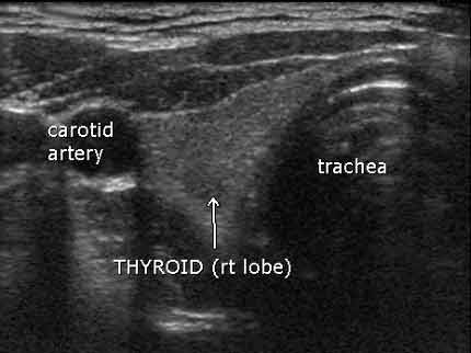 Sonogram of thyroid, right lobe, looking up from chin to the top of the head