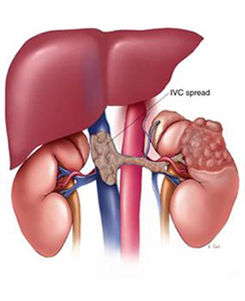 Illustration depicting an Interior Vena Cava tumor spread