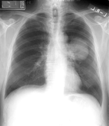 Chest x-ray demonstrating a left-sided lung cancer.