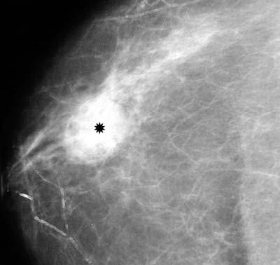 Right breast mammogram shows a tumor (asterisk).