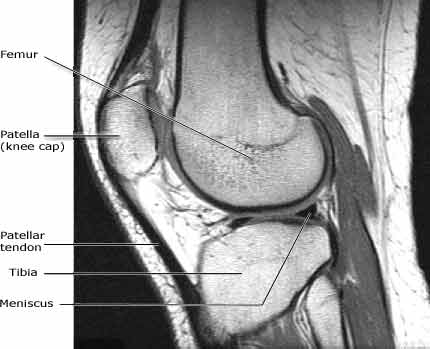 MR of the knee - side (lateral) view, showing distal or lowest part of femur, the patella (knee cap) and proximal (upper) tibia. The lateral meniscus is seen as a dark bow-tie like structure. The patellar tendon is also clearly seen at the front of the knee connecting the patella with the tibia.