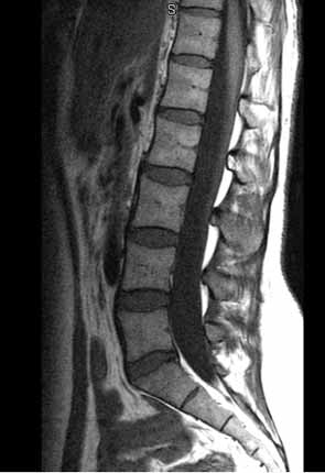 MR lumbar spine, normal