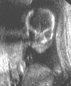 Fetal face - third trimester pregnancy