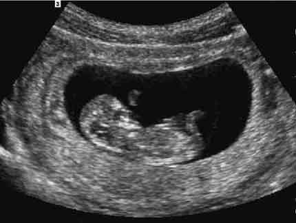 Fetal profile 1st  trimester