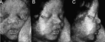 Fetal face 3D ultrasound