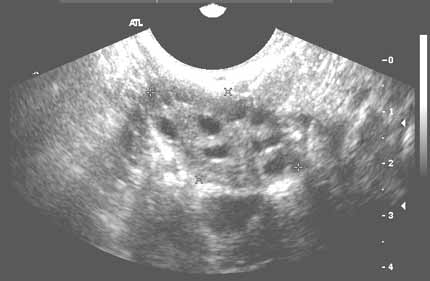 Right ovary - transvaginal showing follicular cysts