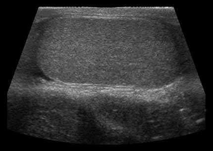 Scrotal sonogram showing side view (longitudinal) of a testicle.  Patient's head to left and feet to right out of the field of view.