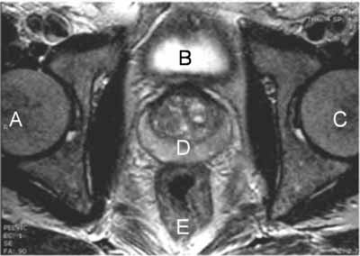 MRI of the Prostate - normal exam. This view is looking up from the feet towards the head of the patient. (A: right hip, B: bladder, C: left hip, D: prostate, E: rectum)