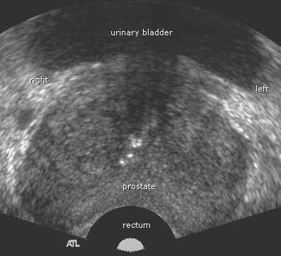 Transrectal sonogram of the prostate. Looking up from the feet of a patient toward his head.