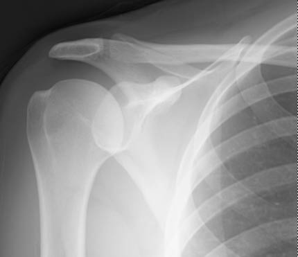 An x-ray of the right shoulder prior to injection of contrast material.