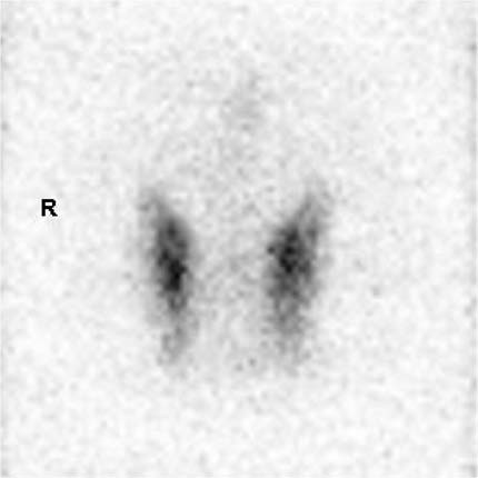 Normal Nuclear Medicine Thyroid Scan. The gland resembles a butterfly with two lobes joined together by a very thin waist. The thyroid gland is normally situated in the front of the lower neck.