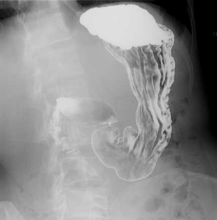 X-ray showing stomach with normal folded lining of the stomach and normal duodenum (first part of small bowel)