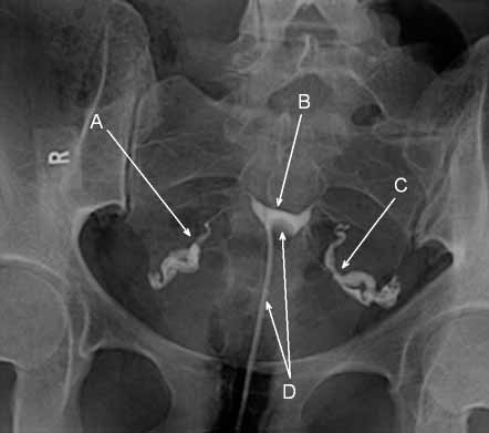 Hysterosalpingogram - contrast (iodine) has been injected into the uterus through a catheter and the uterine cavity and fallopian tubes are opacified - they look white on the image. (A: right tube, B: uterine cavity, C: left tube, D: catheter with balloon tip)