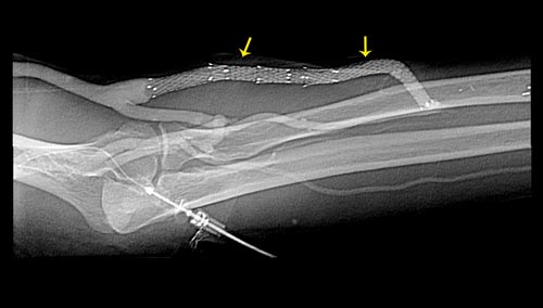 Angiogram of a patient's left arm dialysis fistula demonstrating multiple metallic vascular stents within (yellow arrows).