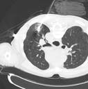 lung CT image