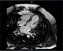 MRI heart video