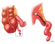 Appendicitis