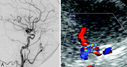 Carotid Artery Stenosis image