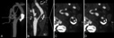 Carotid Artery Stenosis image