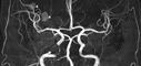 Carotid Artery Stenosis image