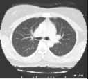 lung CT image