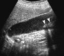 Cholecystitis image