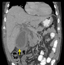 Cholecystitis image