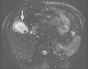 Cholecystitis image