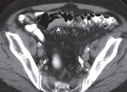 Colorectal Carcinoma image