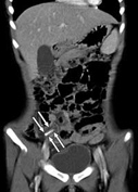 CT appendicitis lesion image