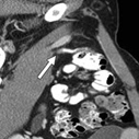 CT appendicitis lumen image