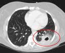 Chest CT image